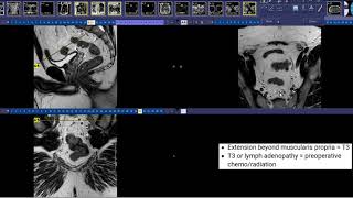 Total colonoscopy  Rectum [upl. by Rizzo667]