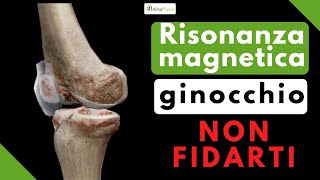 Risonanza magnetica al ginocchio NON FIDARTI [upl. by Monteria]