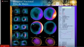 CARDIOLOGÍA NUCLEAR PERFUSIÓN MIOCÁRDICA [upl. by Teillo863]