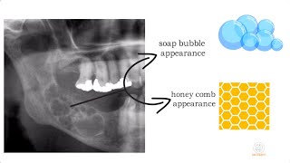 Ameloblastoma part 1 [upl. by Aidas924]