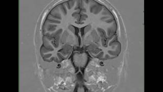 Mesial Temporal Sclerosis Right [upl. by Rafaela]