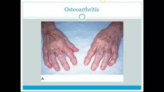 Disorders and Disease of the Skeletal System [upl. by Lohman]