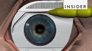 How LASIK Eye Surgery Is Performed [upl. by Onirefes21]