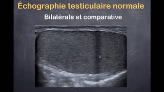 Tumeurs du testicule  1 Imagerie normale [upl. by Kitchen658]