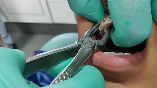 Painless and Easiest method for tooth extraction [upl. by Posehn]