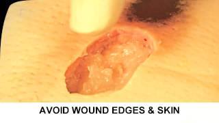 Enzymatic Debridement Demonstration Understand Wound Care [upl. by Batha4]