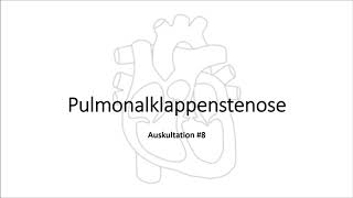 Auskultation 8 Pulmonalklappenstenose [upl. by Leanahtan]