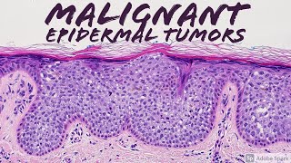 Malignant Epidermal Lesions amp Mimics 101 Carcinoma Basics  Dermatopathology Dermatology Pathology [upl. by Lovato]