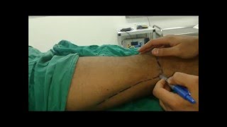 Lateral approach popliteal sciatic block  Peripheral nerve stimulator PNS [upl. by Moran]