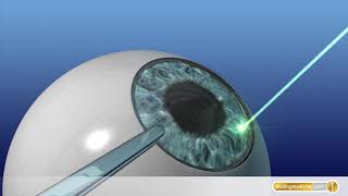 AugenOP mit Laser So funktioniert LASIK [upl. by Ettevahs]