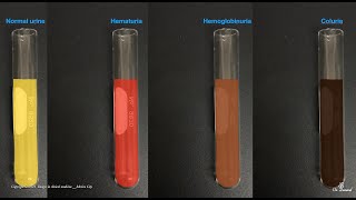 Microscopic Hematuria  CKD ELearning  January 22 2020 [upl. by Acinorehs]