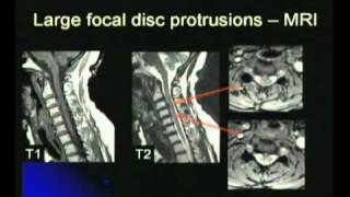 Disc Protrusion [upl. by Tsai]