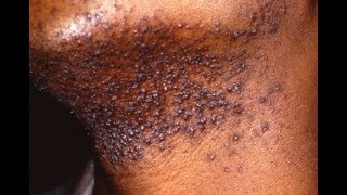 PSEUDOFOLLICULITIS BARBAE Razor Bumps Symptoms Causes Treatment [upl. by Tnarg]