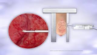 Brevera Breast Biopsy System  Animation [upl. by Eikram]