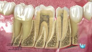 Endodoncia desvitalizar el nervio dental [upl. by Laumas]