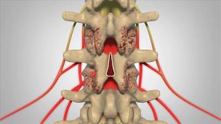 Laminectomy  Patient Education [upl. by Celia491]