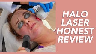 My Halo Laser Experience Honest Review Recovery and Before amp Afters [upl. by Goerke]