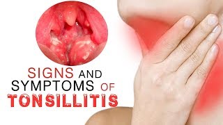 Tonsillitis Causes Signs and Symptoms Diagnosis and Treatment [upl. by Sturdivant]