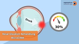 Lasertherapie bei Glaukom MicroCIMM  MUNICH EYE [upl. by Ara174]