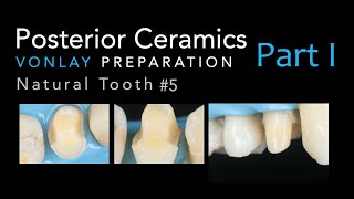 Zirconia Ceramics Part 1 Vonlay Preparation 5 Natural Tooth [upl. by Nichol]