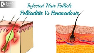 Infected hair follicle What to do Causes Location amp TreatmentDr Rasya Dixit  Doctors Circle [upl. by Jowett]