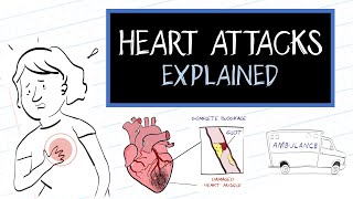 Heart Attack Causes and Risk Factors [upl. by Thacher860]