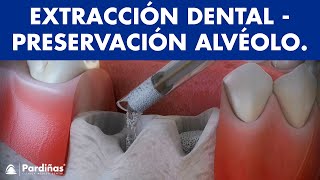 Extracciones dentales  Tratamiento de preservación alveolar © [upl. by Fidelas179]