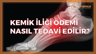 KEMİK İLİĞİ ÖDEMİ NASIL TEDAVİ EDİLİR [upl. by Azilem]