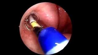 Eustachian Tube Balloon Dilation [upl. by Nnep]