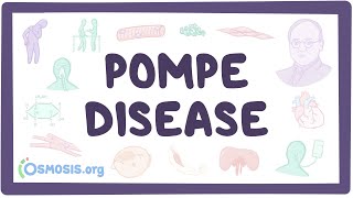 Pompe disease  causes symptoms diagnosis treatment pathology [upl. by Colpin]