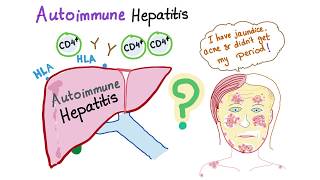 Autoimmune Hepatitis Lupoid hepatitis [upl. by Olag]