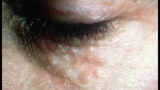 Syringoma removal naturally FAST at home  My Experiment w Transformation Results [upl. by Bonni]