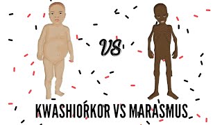 SAM  Severe Acute Malnutrition  Kwashiorkor VS Marasmus [upl. by Ruder]