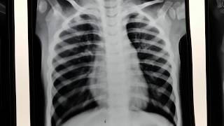 Hyperinflated chest x ray [upl. by Yeldahc]