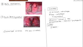 Tonsilitis [upl. by Hofmann653]