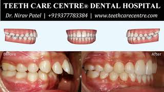 Invisalign Before and After  Lower Jaw Advancement [upl. by Notnef]