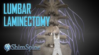 Lumbar Laminectomy [upl. by Ennovehc]