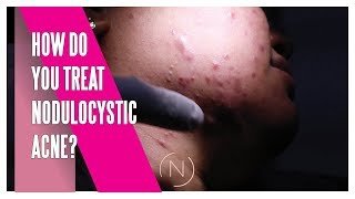 How Do You Treat Nodulocystic Acne  Houston Dermatology [upl. by Jone]