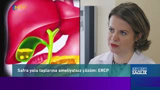 Safra Yolu Taşlarının Endoskopik Tedavisi ERCP [upl. by Maurine625]