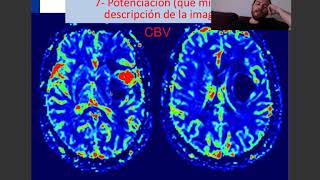 Perfusion en RM Revision de Taller caso clinico en tumor cerebral [upl. by Eolcin]