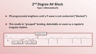 Intro to EKG Interpretation  AV Block [upl. by Renelle]