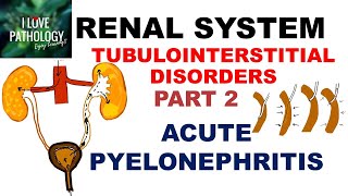 ACUTE PYELONEPHRITIS Pathology [upl. by Nnylyrehc]