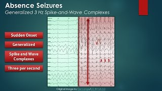 Absence Seizures EEG Findings [upl. by Leiser]