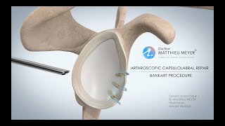 ARTHROSCOPIC SHOULDER STABILISATION BANKART PROCEDURE  DR MATTHIEU MEYER  PARIS FRANCE [upl. by Willem608]