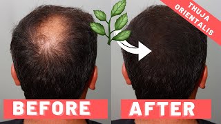 Thuja Orientalis For Hair Loss [upl. by Romeyn]