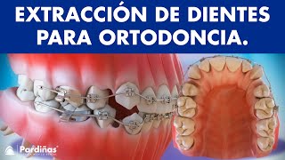 Extracción de dientes en ortodoncia © [upl. by Kalle]