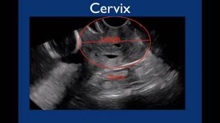 Pelvic Ultrasound [upl. by Gibeon738]