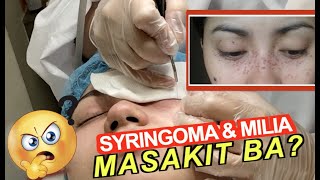 SYRINGOMA amp MILIA REMOVAL MASAKIT BA  Miss Menchie [upl. by Sivi67]