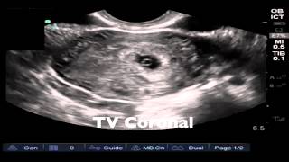 Introduction to pelvic ultrasonography [upl. by Atirihs]