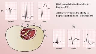 Intro to EKG Interpretation  Bundle Branch Blocks [upl. by Areht]